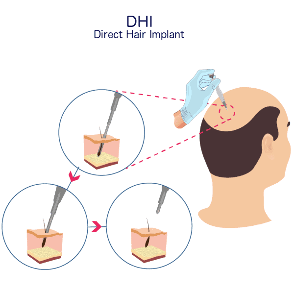کاشت مو با استفاده از تکنیک DHI (Direct Hair Implantation)