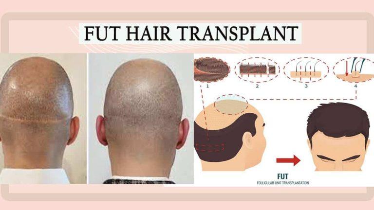 کاشت مو با استفاده از روش FUT (Follicular Unit Transplantation)