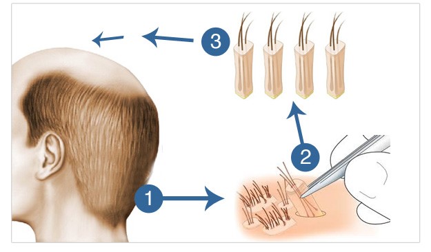 کاشت مو با استفاده از روش FUE (Follicular Unit Extraction)