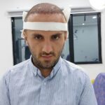 کاشت مو سنندج