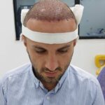 کاشت مو سنندج