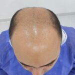 کاشت مو در سنندج