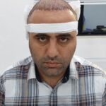 کاشت مو در سنندج