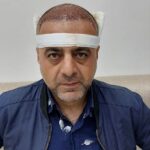 نمونه کار کاشت مو در سنندج