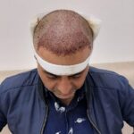 نمونه کار کاشت مو در سنندج