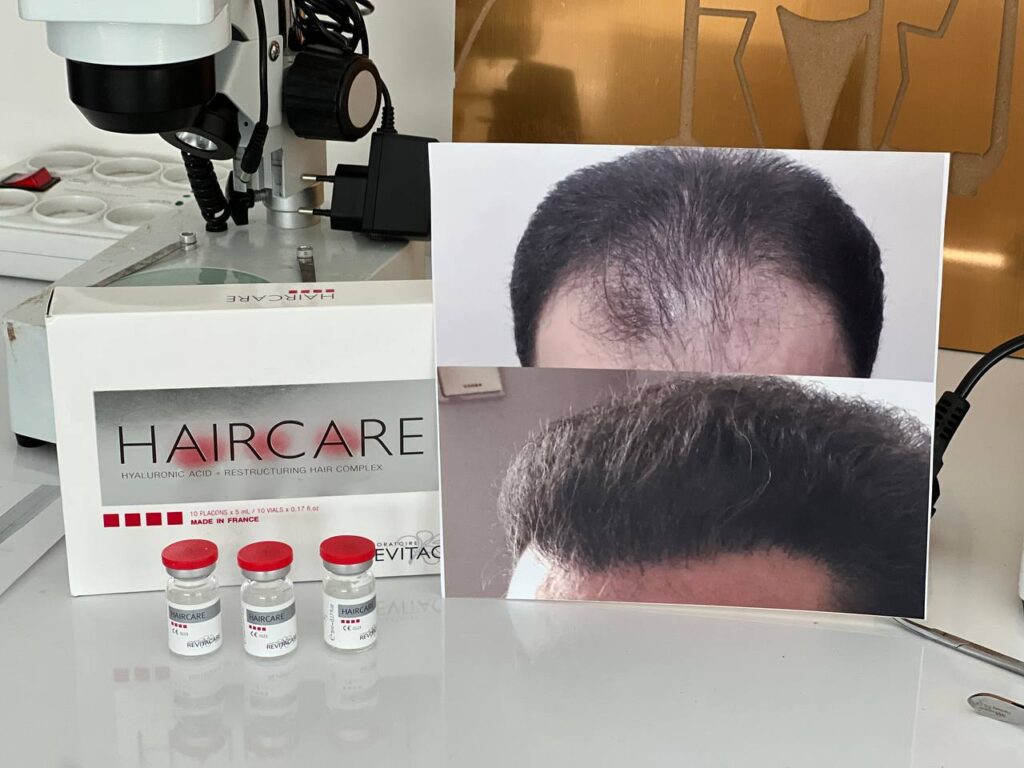 مزوتراپی در سنندج